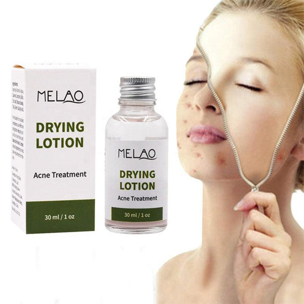 Melao Drying Lotion :-30 ml - BlushyLady